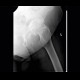 Myositis ossificans, ossifying tendon, adductor magnus, tuberosity of ischium: X-ray - Plain radiograph